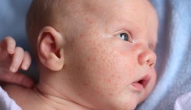 acne de bebe